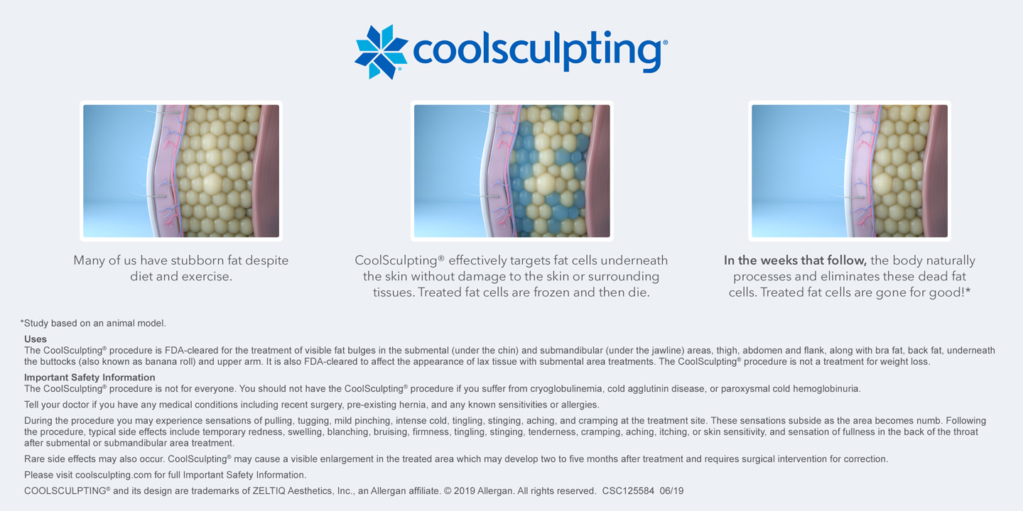 CoolSculpting infographic